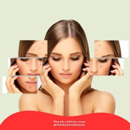 The 10 causes of acne-prone skin