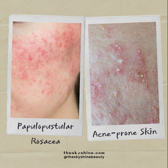 Is it Acne or Papulopustular Rosacea?
1. Distinguishing Rosacea From Acne
Redness vs. Pimples: Rosacea mainly shows up as redness in the middle of your face. Acne usually includes blackheads, whiteheads, and small bumps filled with pus
