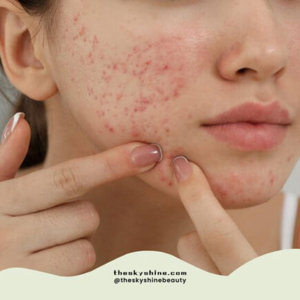 Is it Acne or Papulopustular Rosacea?